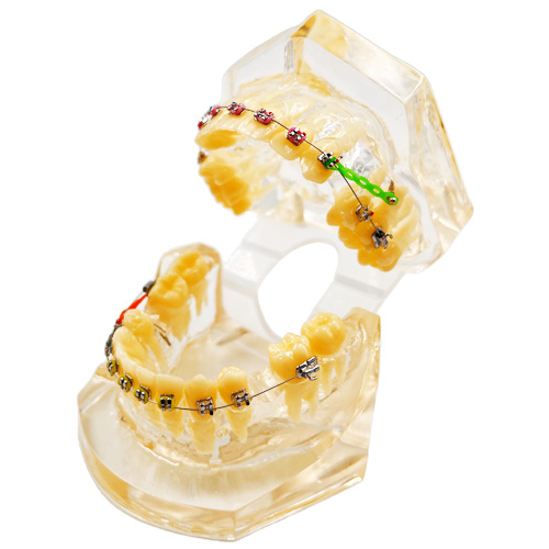 مولاژ دندان بعد از ارتودنسی
