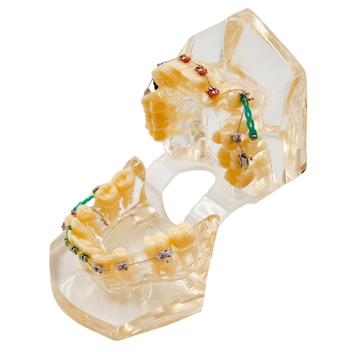 مولاژ دندان مدل قبل از ارتودنسی